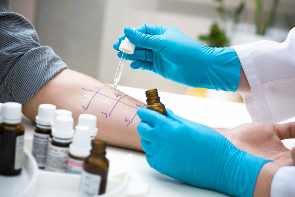un dottore esegue un prick test per rilevare l'entità di un'allergia