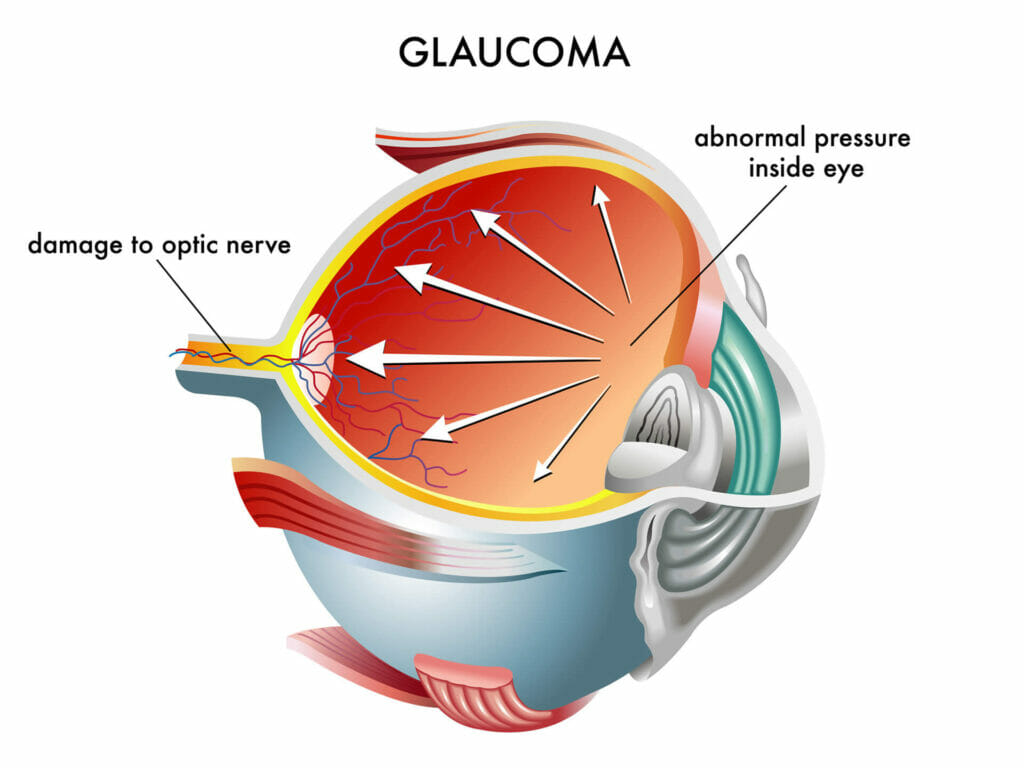 illustrazione che mostra cos'è un glaucoma