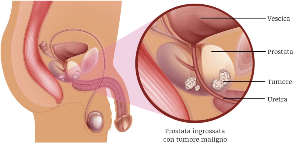 tumore-della-prostata-anatomia