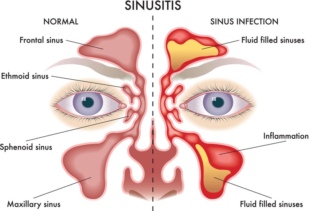 sinusite-adulto-anatomia-seni-paranasali